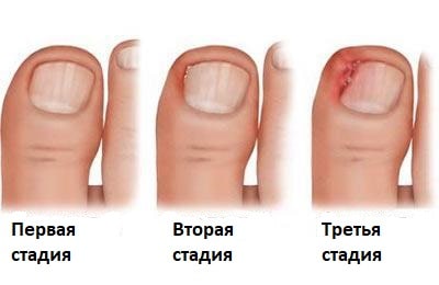 стадии врастания ногтя